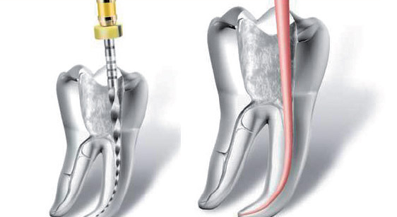 Endodontie Bild 1