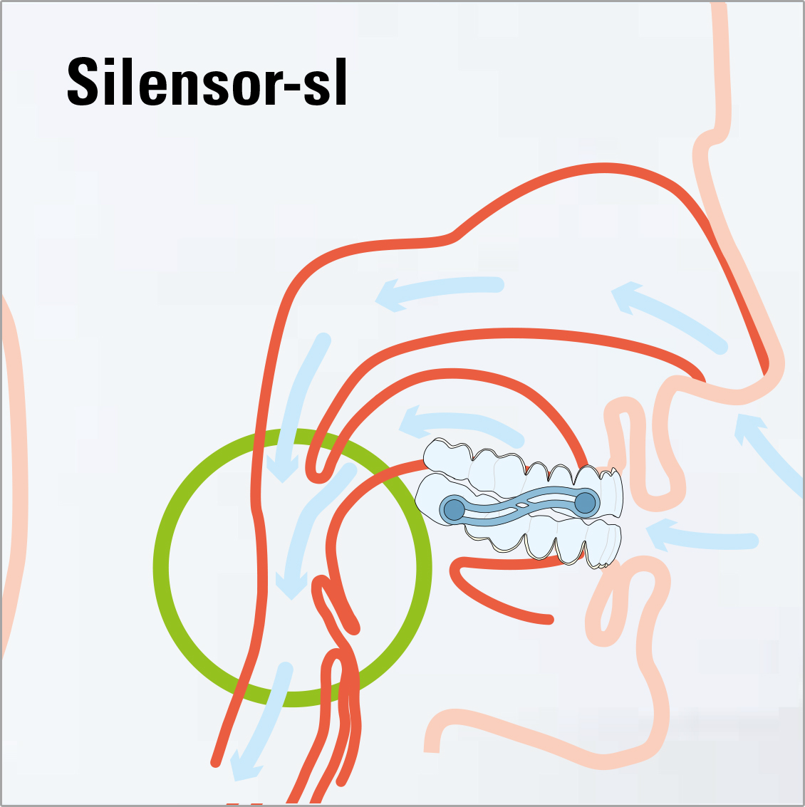 Der Silonsor-SL